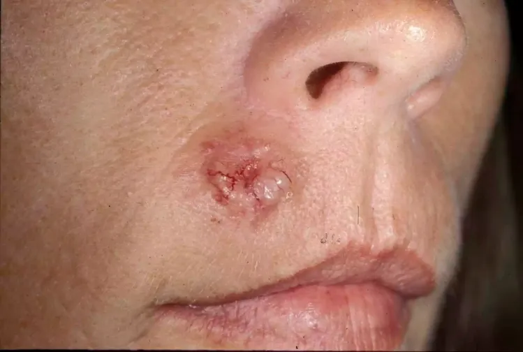 Basal Cell Carcinoma (BCC)