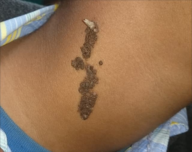 Cutaneous Horn
