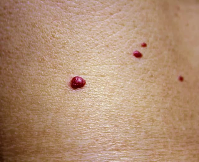 Cherry Angiomas