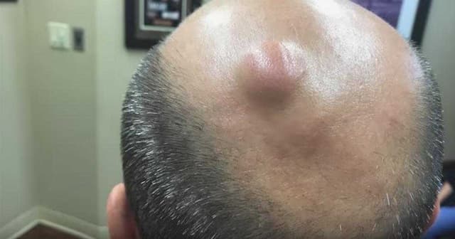 Epidermoid Cysts