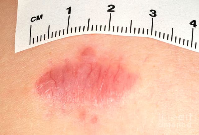 Skin Fibromas (Dermatofibromas)