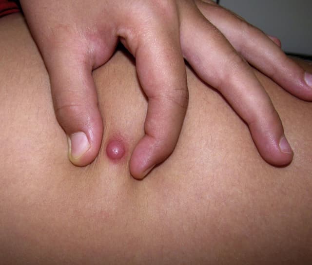 Dermatofibrosarcoma Protuberans (DFSP)