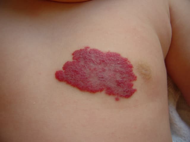 Hemangiomas