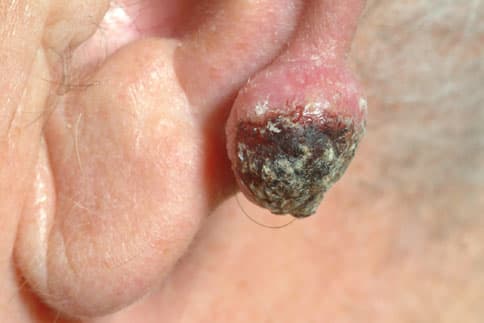 Keratoacanthoma