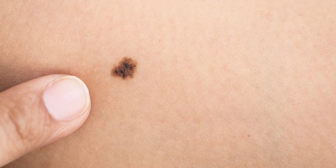 Melanoma