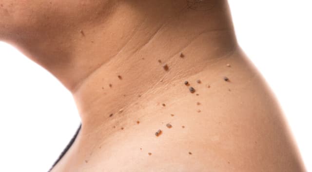 Skin Papillomas (Warts)