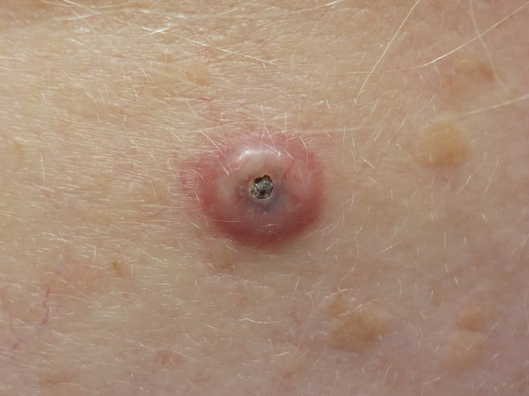 Squamous Cell Carcinoma (SCC)