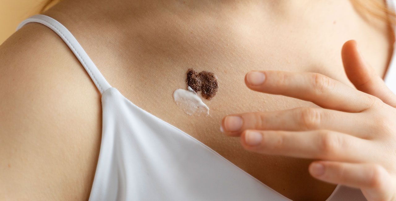 Topical Chemotherapy
