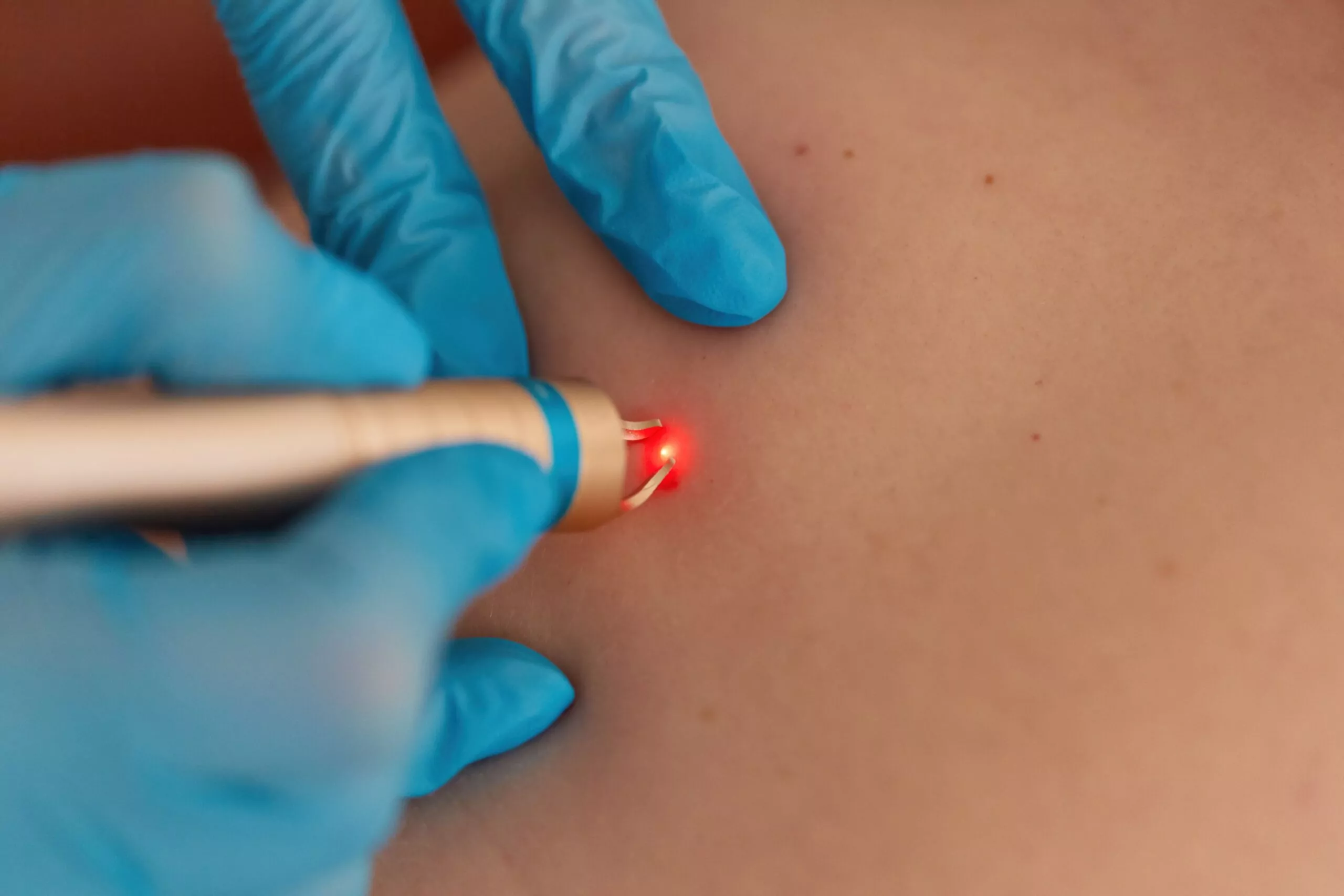 CO2 laser ablation