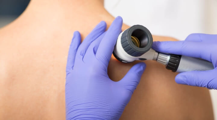 Inspection with dermatoscope (Non-invasive)
