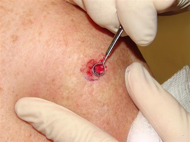 Electrodesiccation and curettage (ED&C)