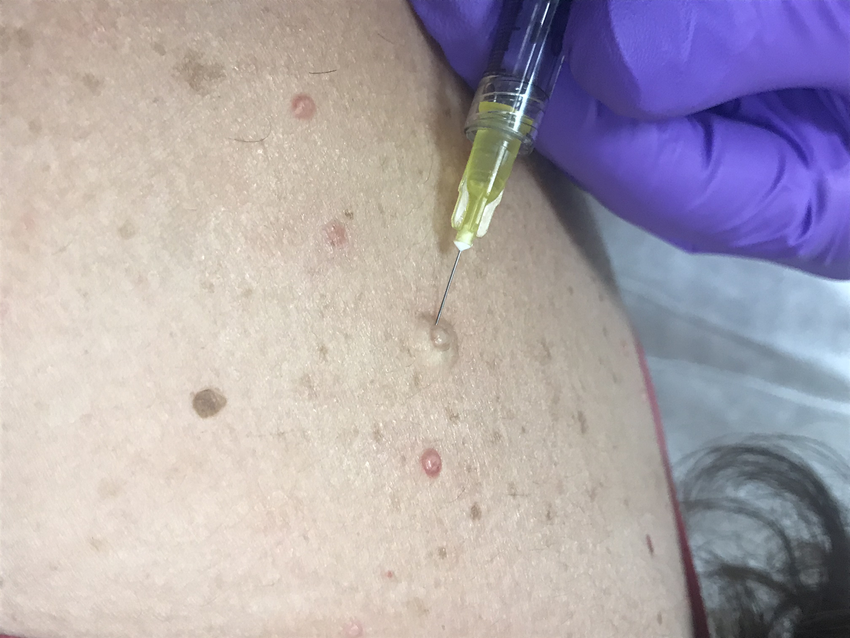 Intralesional Chemotherapy