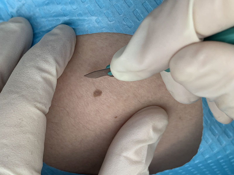 Biopsies (Invasive)