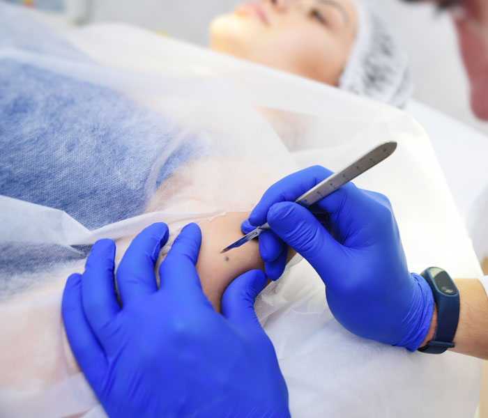 Surgical Excision