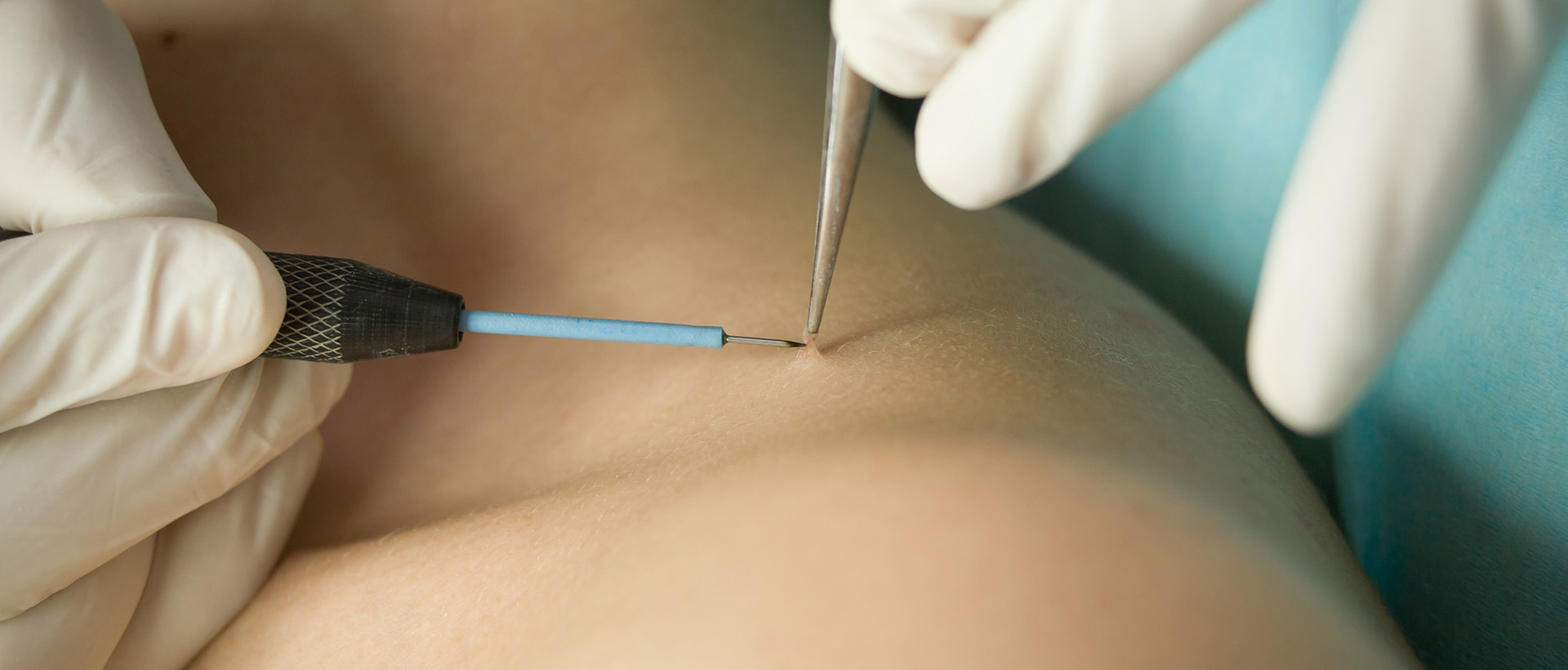 Surgitron surgery