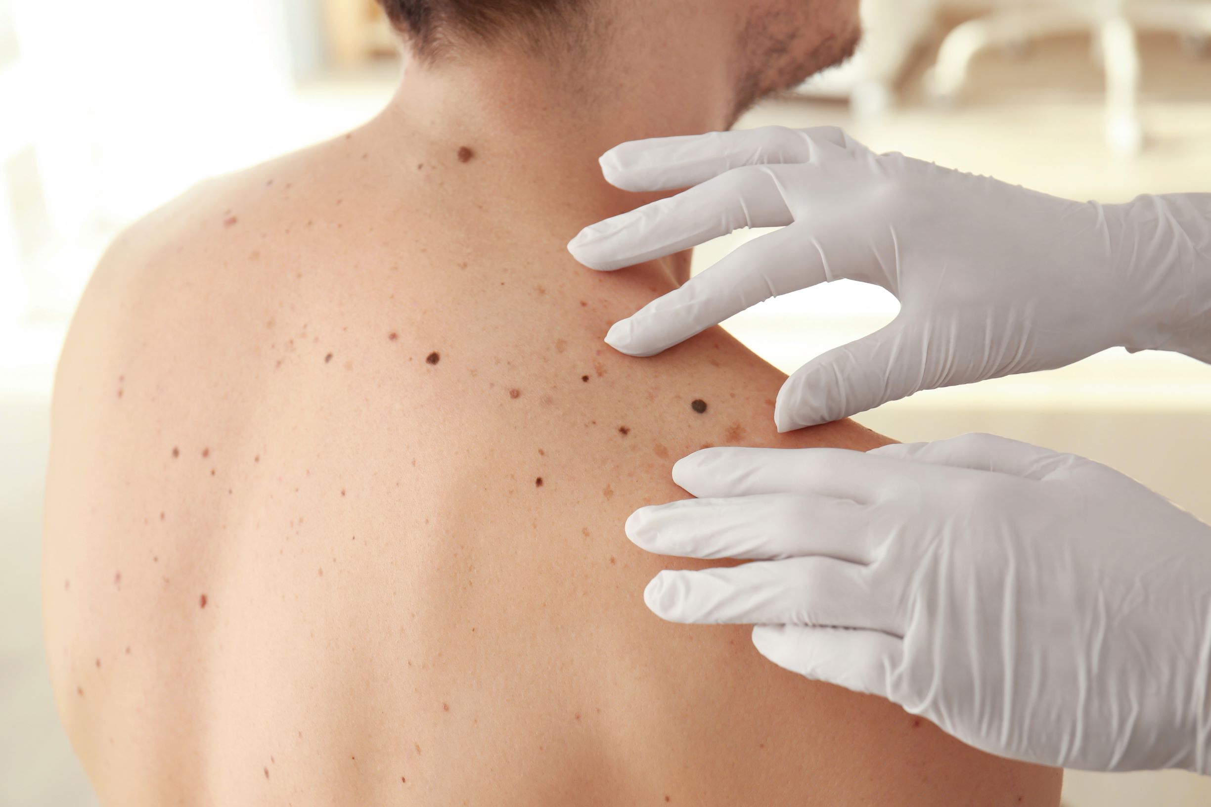 A total body skin exam (TBSE)